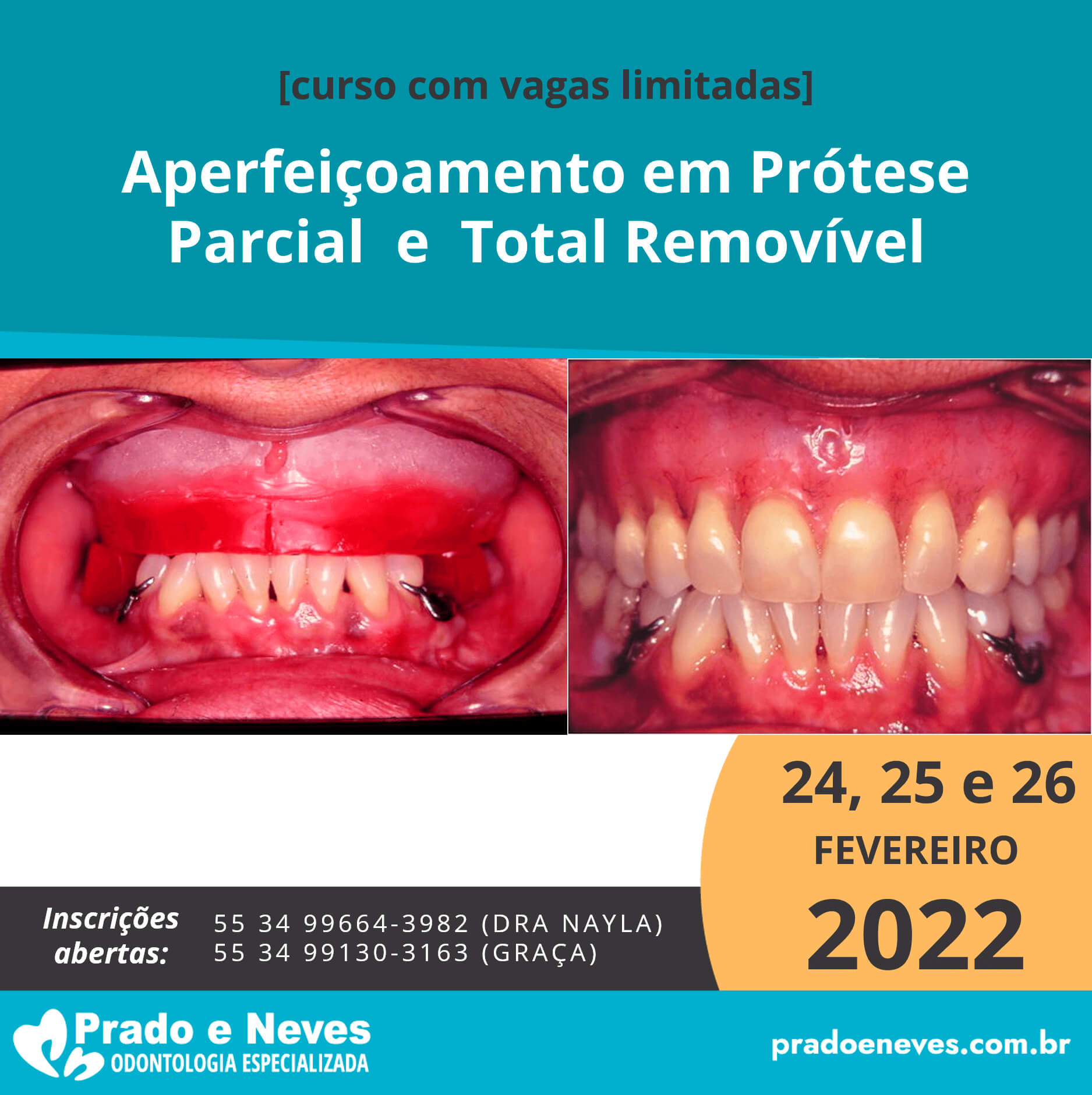 Aperfeiçoamento em Prótese Parcial e Total Removível