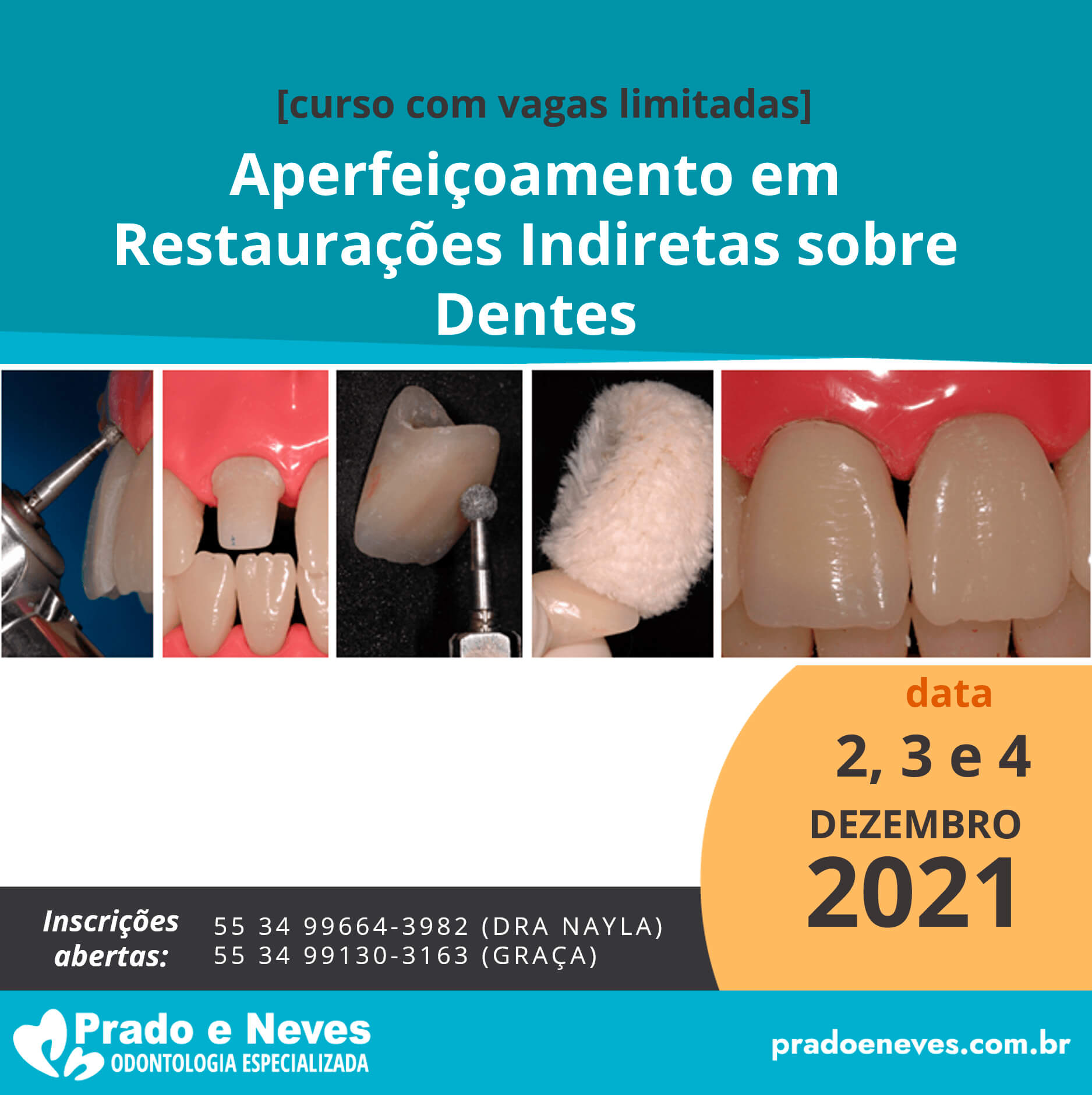 aperfeiçoamento em restaurações indiretas sobre dentes