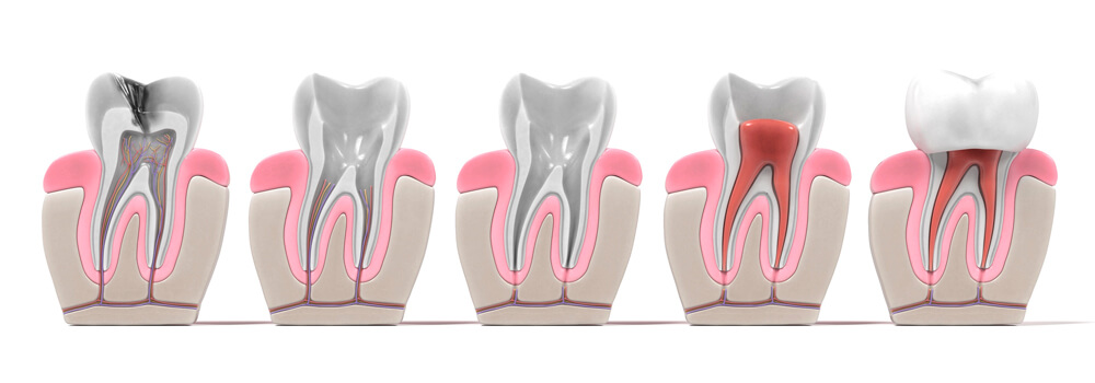 Endodontia | Dentista Em Uberlândia | Prado E Neves