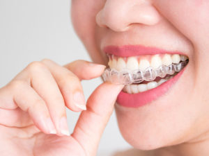 invisalign