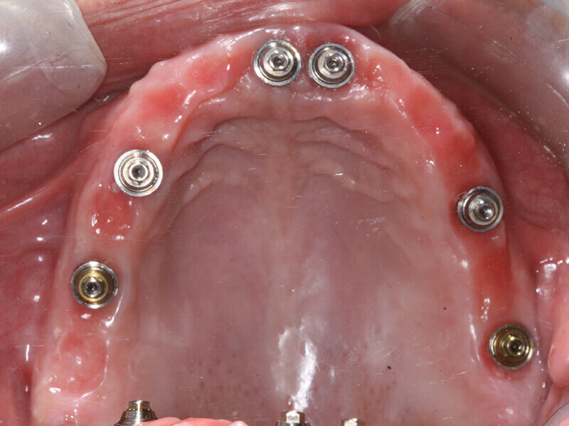 protocolo de prótese