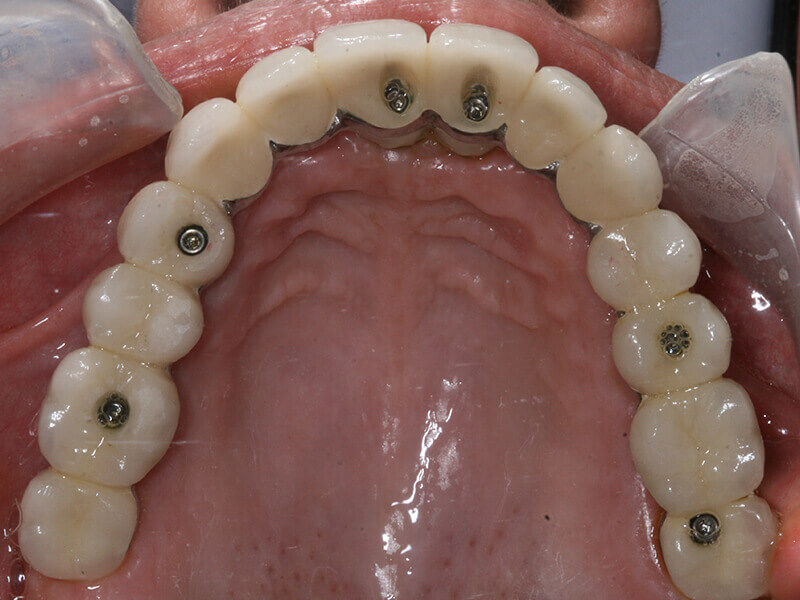 protocolo de prótese